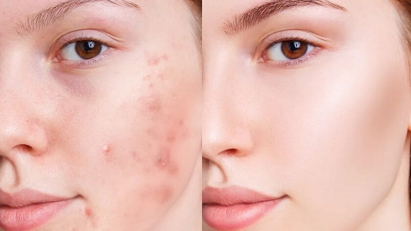15 روش برای جلوگیری از جوش و آکنه